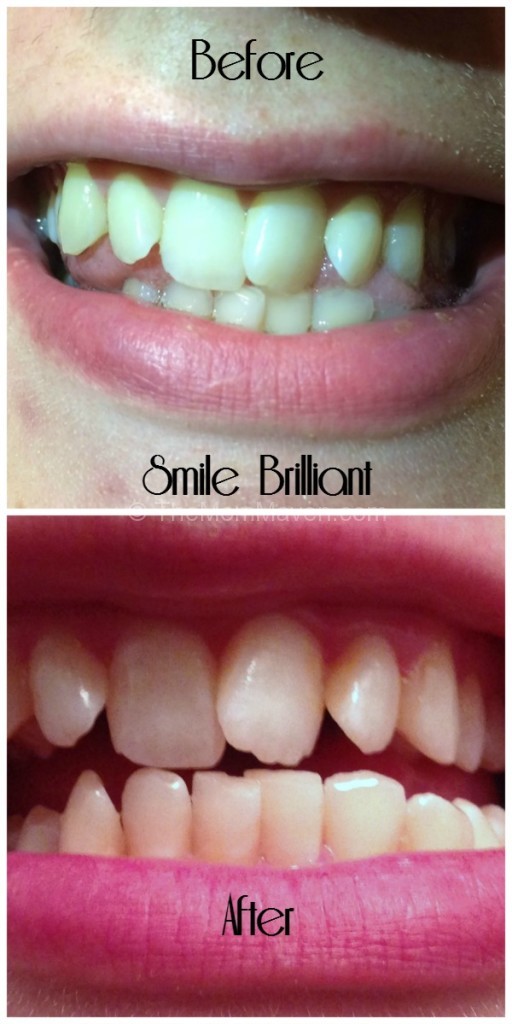 Smile Brilliant Before and After